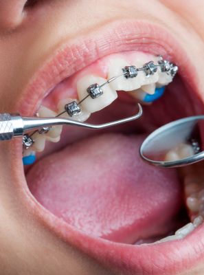 Extração do dente siso para pacientes que já estão em tratamento ortodôntico. Veja como é feito!