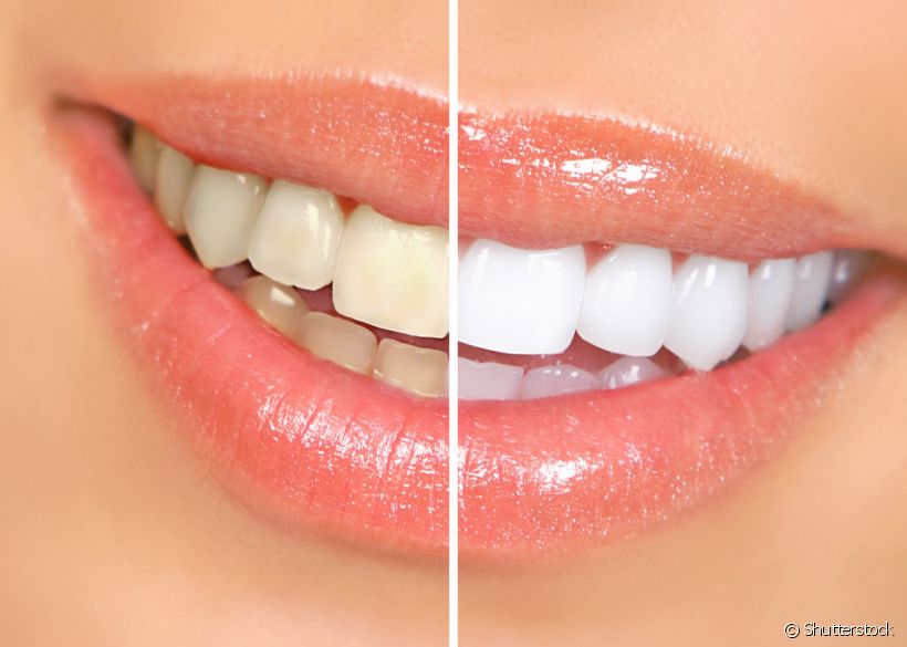 Clarear os dentes requer responsabilidade do paciente de escolher os métodos que não danificam o dente ou prejudicam sua saúde bucal. Você sabe quais são eles?