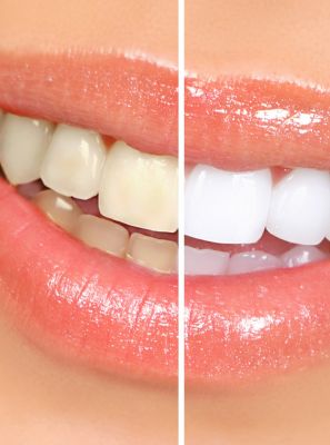 Como clarear os dentes de forma segura e sem prejuízos à saúde bucal?