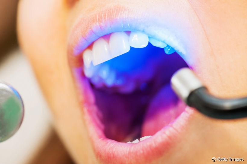 Você tem medo do motorzinho dos dentistas? Confira 5 tratamentos inovadores para a cárie para passar bem longe dele!