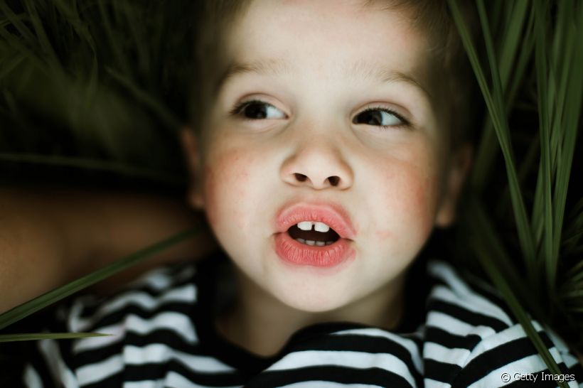 Conhecida por formar pequenas manchinhas sobre os dentes, a fluorose deve ser tratada para que o sorriso não seja comprometido. Saiba mais sobre o tratamento