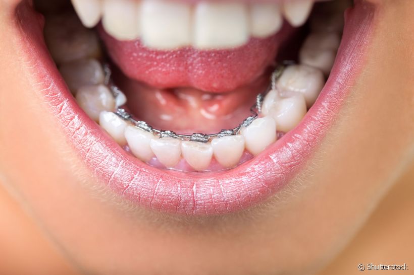 O aparelho lingual é uma das opções de tratamento ortodôntico para alinhar os dentes, mas será que ele pode causar a cárie dentária?