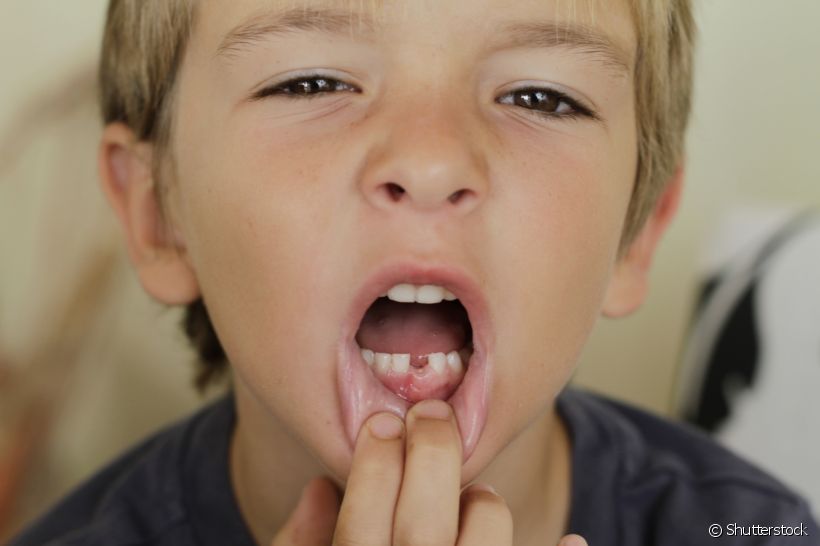 Seu filho está com uma bolha na gengiva no lugar do dente? Descubra o que isso pode ser!