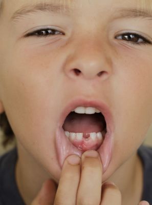 Bolha na gengiva da criança: o que pode ser? Tem a ver com o nascimento da dentição permanente? Odontopediatra explica