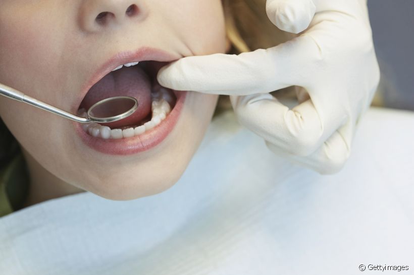 O seu dente siso nasceu e não causa nenhum incômodo. Será que mesmo assim você deve tirar?