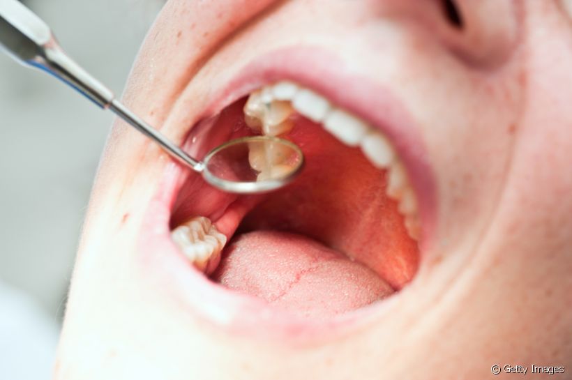 Descubra se o buraco no dente tem relação com a cárie e como tratar esse incômodo