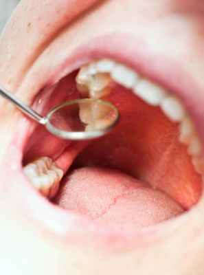 Buraco no dente pode ser cárie? Entenda os motivos dessa abertura e os riscos para a saúde bucal