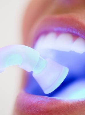 Laserterapia na ortodontia: o que é? Para que serve? Conheça os benefícios da técnica para o tratamento ortodôntico