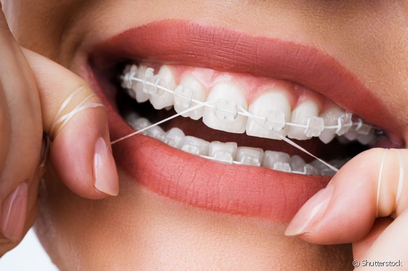 O fio dental é um dos produtos de higiene bucal que pode facilitar limpeza dos dentes com aparelho ortodôntico. Conheça outros cuidados para incluir nesse ritual!