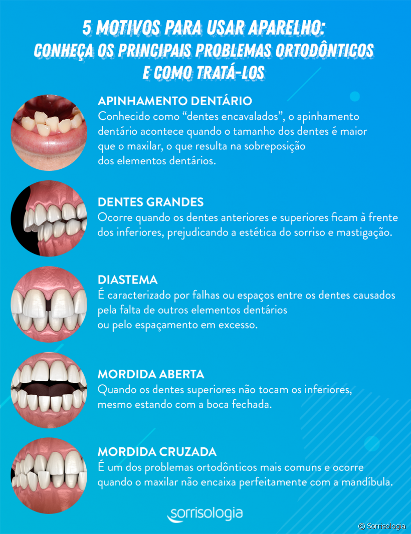 Ortodontista esclarece os principais problemas nos dentes que motivam o uso do aparelho ortodôntico
