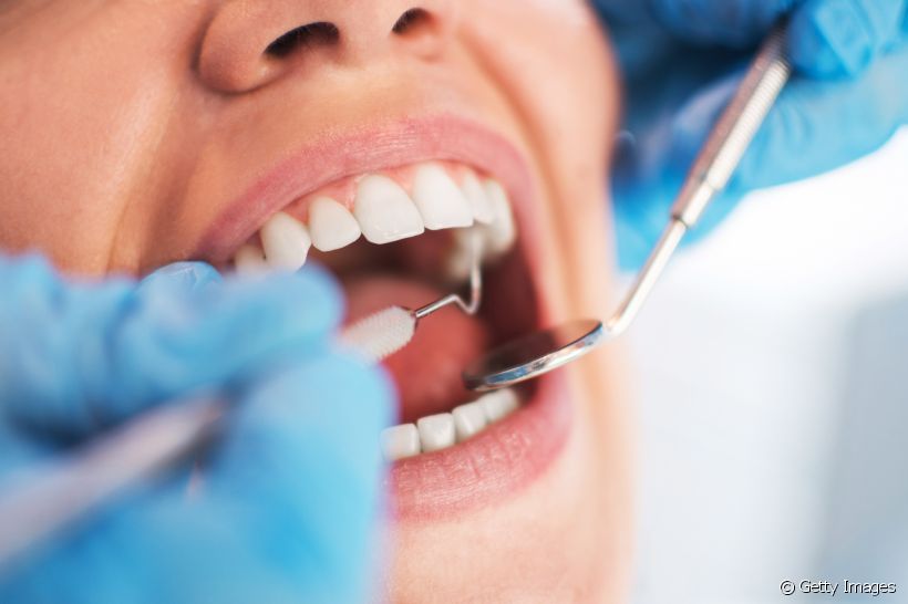 Saiba quanto tempo dura um curativo de dente e os cuidados necessários durante o uso do selante