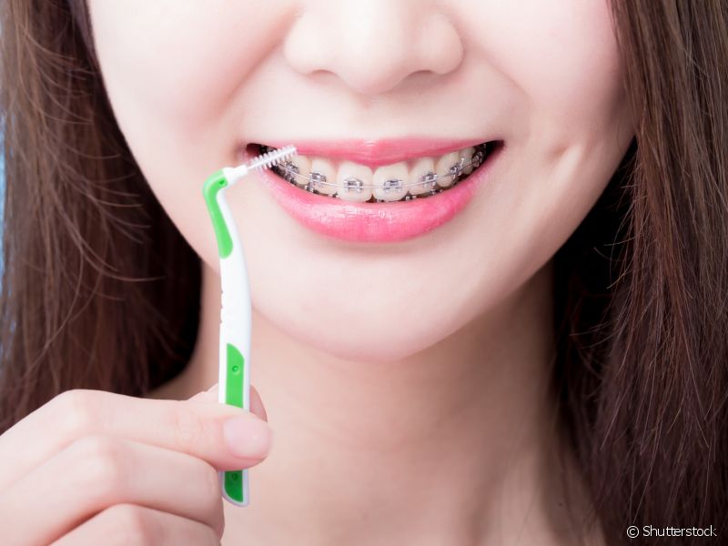 Use a escova interdental para garantir uma limpeza mais eficaz nos espaços entre os dentes e ao redor dos braquetes.