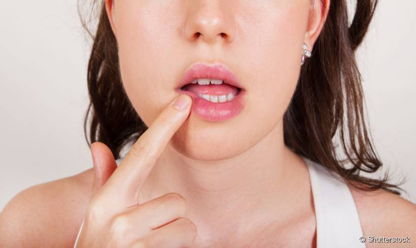 Aftas são lesões que podem ser bastante doloridas e surgem na mucosa bucal, gengiva ou língua
