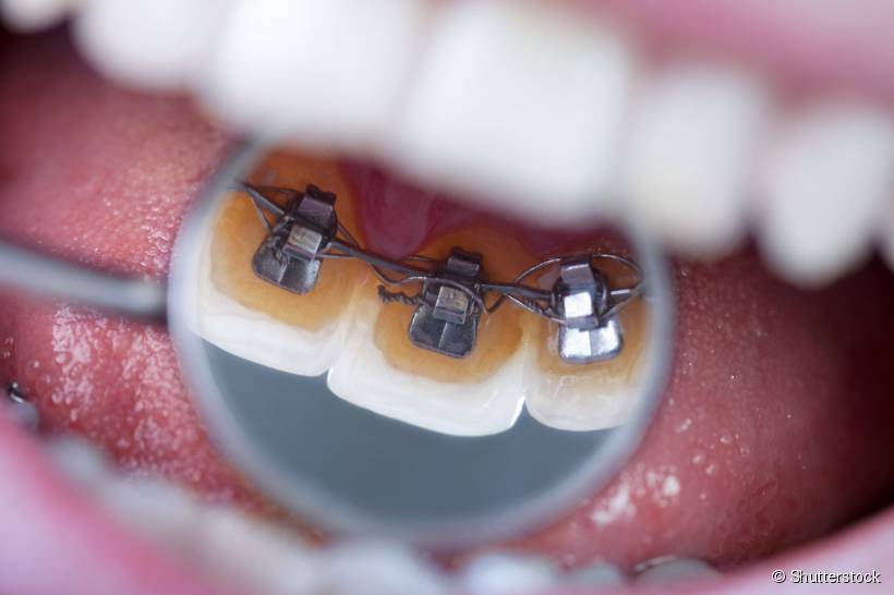O tratamento é bastante indicado para adultos que necessitam corrigir seus dentes de maneira elegante e discreta