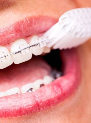 Para quem usa aparelho dentário, escova ortodôntica é a melhor opção para a higiene bucal