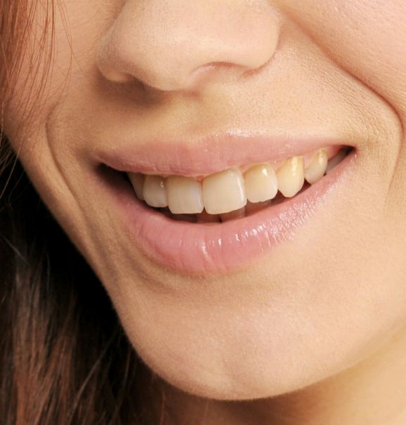 O clareamento dental é a técnica que se tornou muito popular nos últimos anos devido ao apelo estético por dentes brancos e bem alinhados