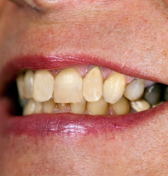 Para retirar o tártaro, só indo ao dentista. Através de uma limpeza profunda ele retira toda a placa bacteriana, deixando os dentes mais saudáveis e livre da sujeira