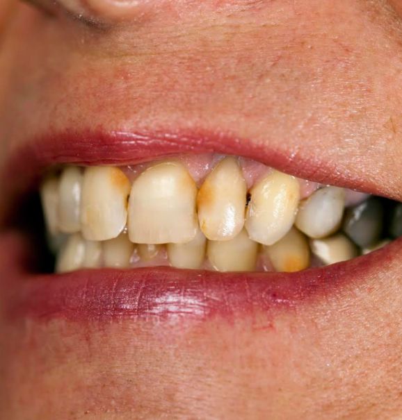 Para retirar o tártaro, só indo ao dentista. Através de uma limpeza profunda ele retira toda a placa bacteriana, deixando os dentes mais saudáveis e livre da sujeira