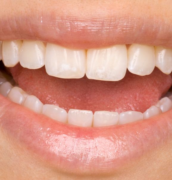 Quando alguém quebra parte ou todo o dente precisa passar por uma restauração dental, que tem como objetivo restaurar o dente ao seu formato original, melhorando a forma, função e aparência