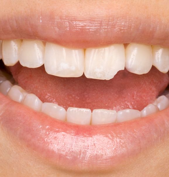 Quando alguém quebra parte ou todo o dente precisa passar por uma restauração dental, que tem como objetivo restaurar o dente ao seu formato original, melhorando a forma, função e aparência