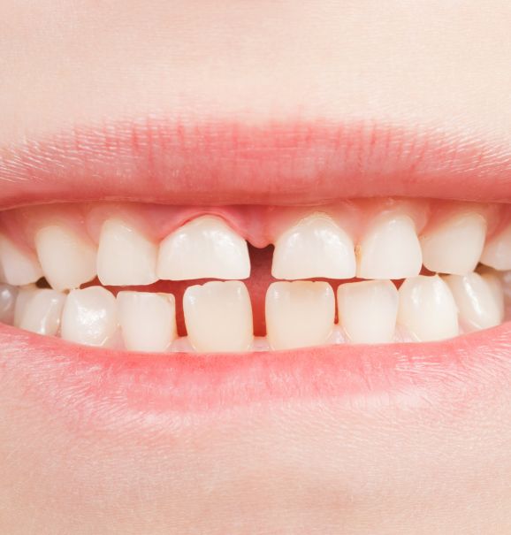 Dentição infantil: entenda sobre a troca de dente de leite pelo dente permanente
