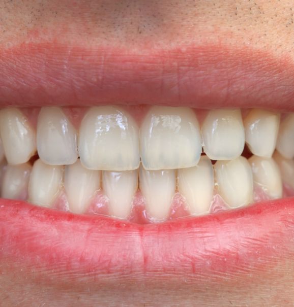 Nada melhor que corrigir aquele problema dentário que tanto te incomoda, né? Para isso, você pode contar com a ajuda da Ortodontia, especialidade que previne e corrige anormalidade no alinhamento dos dentes