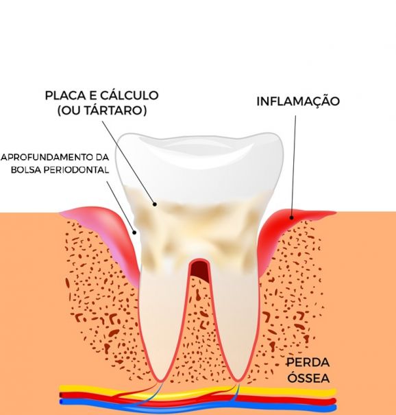Antes e depois: conheça os sintomas da doença periodontal no dente e gengiva e como eles ficam quando estão saudáveis