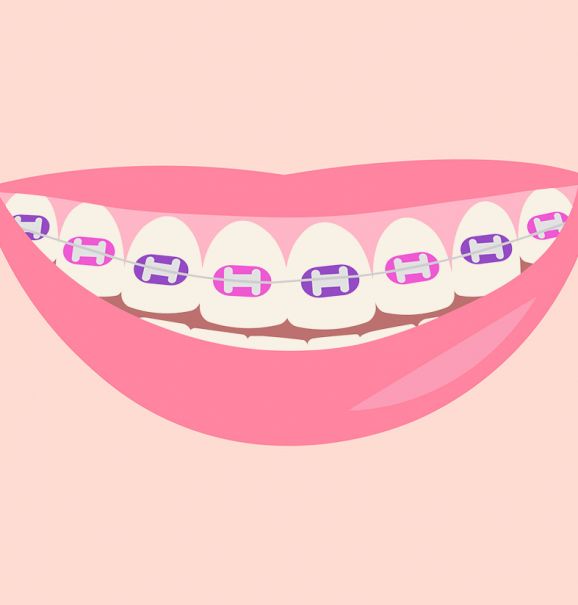 Acha que seus dentes estão mais amarelados após o retirar o aparelho ortodôntico? Não é mera coincidência. Confira dicas de como contornar esse quadro!