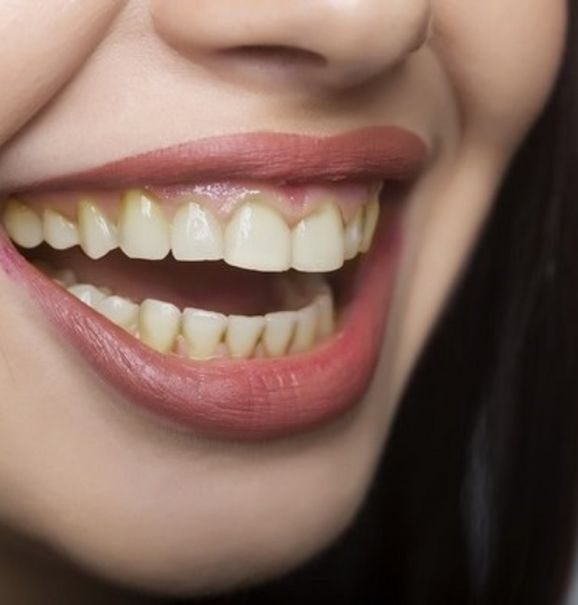 Pensando em dar um up no seu sorriso? Com as facetas dentárias isso se torna real, e uma coisa é certa: o resultado fica incrível