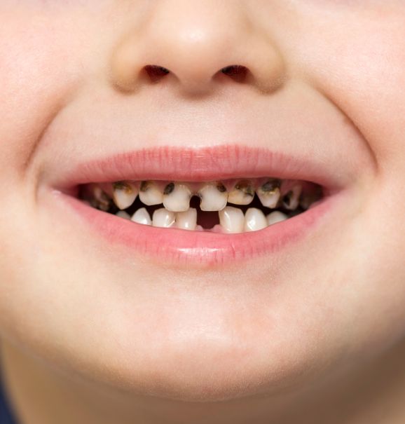 Um sorriso cariado pode afetar a saúde dos dentes e a autoestima do paciente. Por isso, a melhor alternativa é buscar ajuda especializada para que o tratamento seja feito, e o sorriso seja recuperado