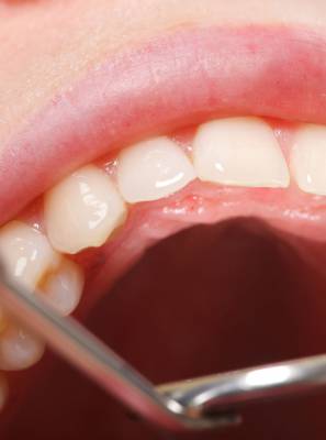 Entenda as causas e riscos dos dentes inclusos para a saúde bucal