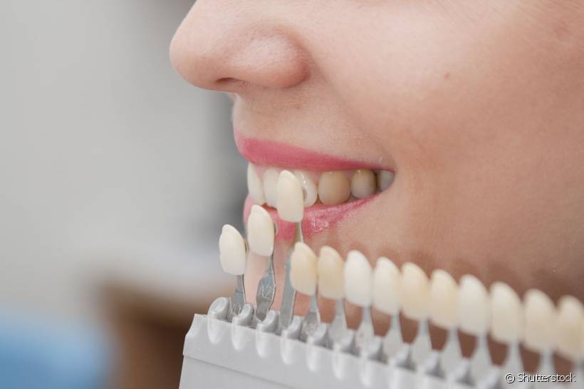 Um dos procedimentos mais avançados na estética bucal, a aplicação das facetas de porcelana é um procedimento estético ideal para quem deseja melhorar a aparência de seus dentes
