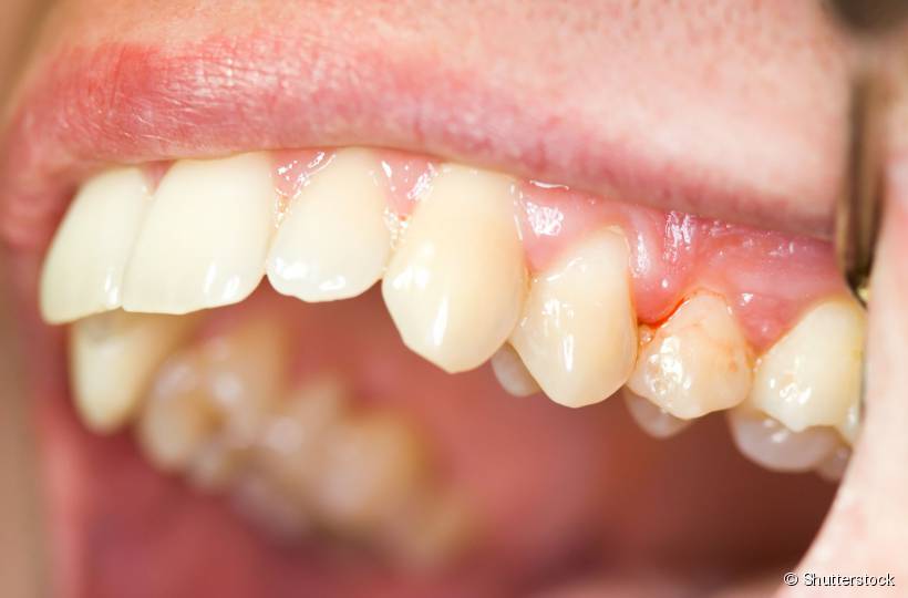 Sensibilidade dentária ou gengiva avermelhada e inchada também podem indicar o surgimento de uma gengivite 