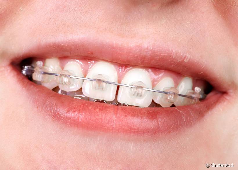 Se o dentista disser que seu filho precisa extrair os dentes de leite para realizar o tratamento ortodôntico, não se assuste! De acordo com a profissional Andreia Cotrim isso é mais comum do que se pensa