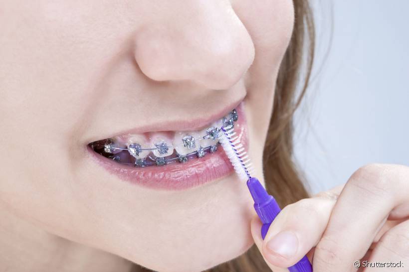 A escova interdental ajuda a tirar todos os resíduos que ficam ao redor do aparelho e nos espaços maiores entre os dentes