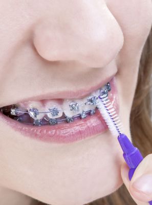 Usar o fio dental, evitar o consumo de doces: confira 7 dicas para ter um tratamento ortodôntico de sucesso