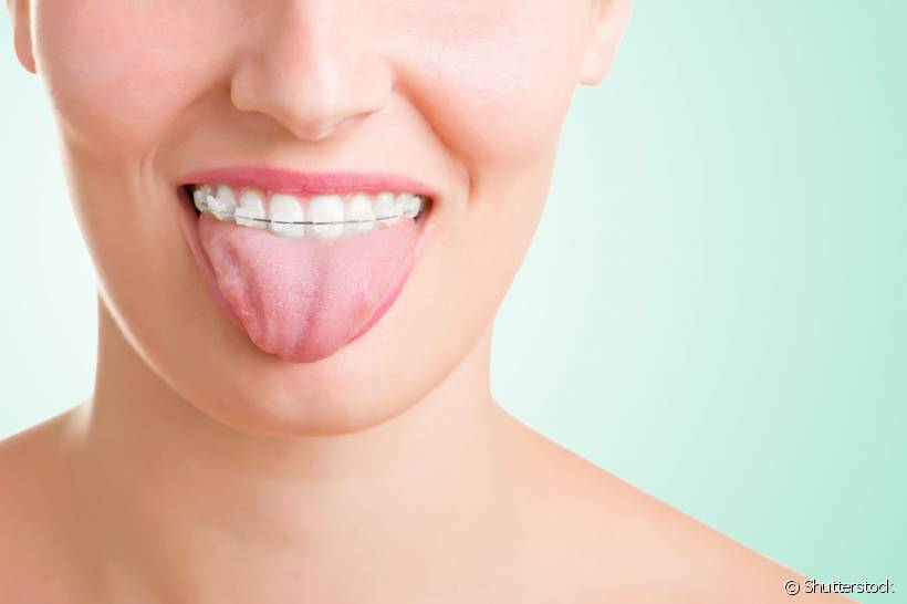Você conhece importância de limpar a língua durante a higiene bucal? Pessoas em tratamento ortodôntico devem ficar ainda mais atentas quanto a isso. Confira as dicas do profissional Flávio Cotrim