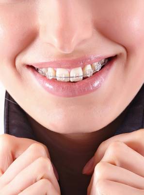 5 situações que só quem usa aparelho dentário vai entender