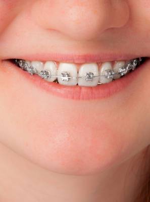 Você sabe lidar com seu tratamento ortodôntico? Confira como passar o fio dental usando aparelho fixo