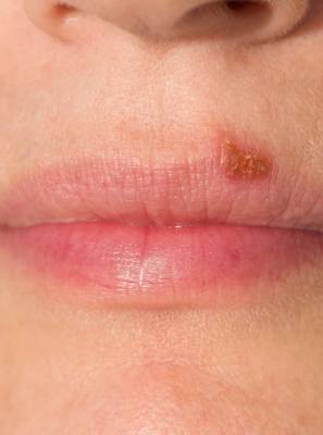 Herpes na boca: o vírus é transmitido por meio de objetos? Desvendamos 5 mitos e verdades