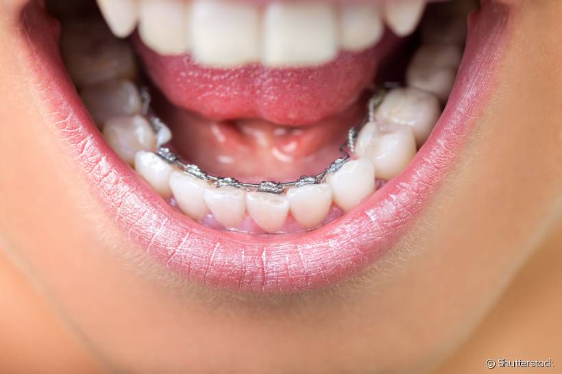 Ortodontia lingual: você já ouviu falar? Conversamos com a dentista Andreia Cotrim para entender o que é mito e o que é verdade sobre esse tratamento