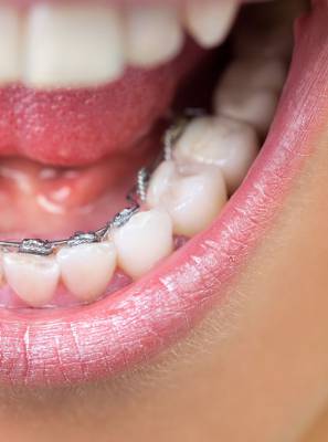 Esclareça as dúvidas sobre o tratamento de ortodontia lingual