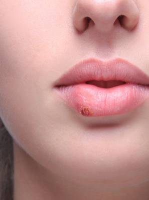 Herpes na boca: 3 cuidados simples para evitar o surgimento das lesões