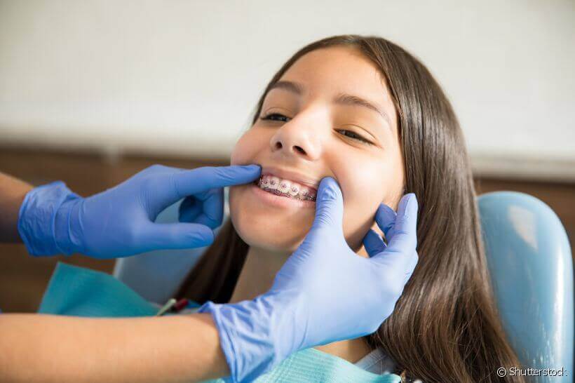Entenda a função dos parafusos de ancoragem na ortodontia e os cuidados necessários durante o tratamento ortodôntico