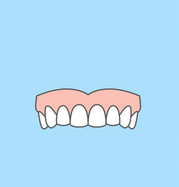 Antes e depois da fluorose dentária: conheça todas as opções de tratamento para remover as manchas brancas dos dentes