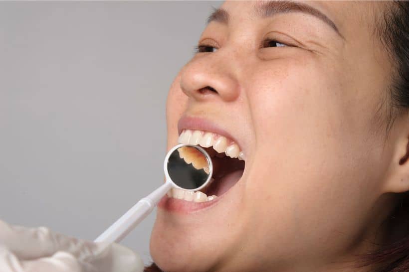 As bactérias na boca se tornam um problema para a saúde bucal quando a microbiota oral está desequilibrada.