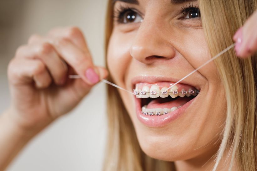 O uso do fio dental é ainda mais importante durante o tratamento ortodôntico. Saiba como passar o fio dental com aparelho dental