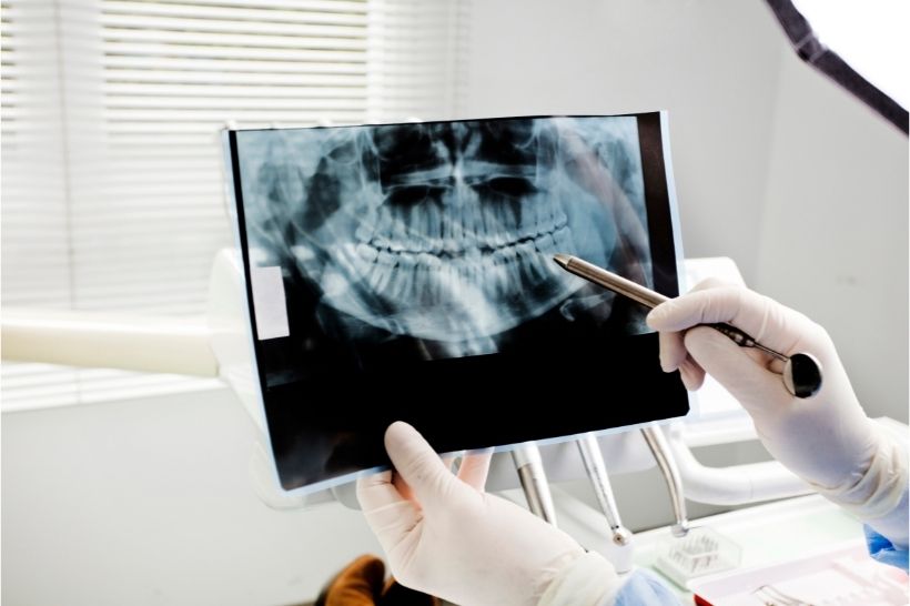 Para garantir um bom diagnóstico, devem ser realizados alguns exames clínicos e radiografias durante a consulta odontológica.