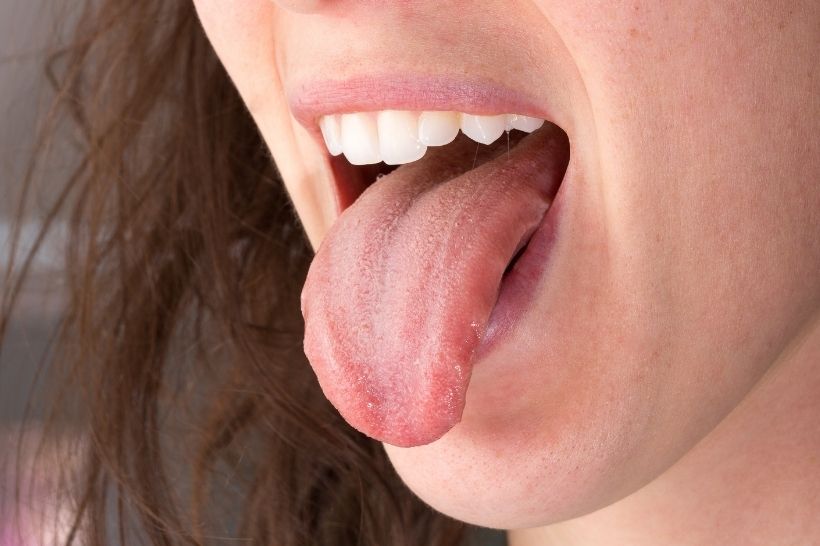 Língua geográfica: saiba mais sobre os sintomas e os cuidados com a doença bucal