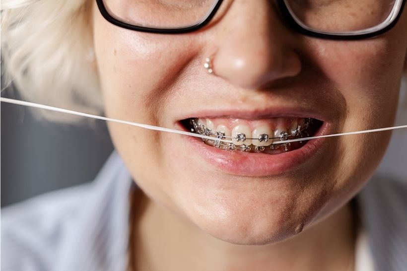 Descubra os melhores tipos de fio dental para quem usa aparelho e mantenha a sua saúde bucal em dia